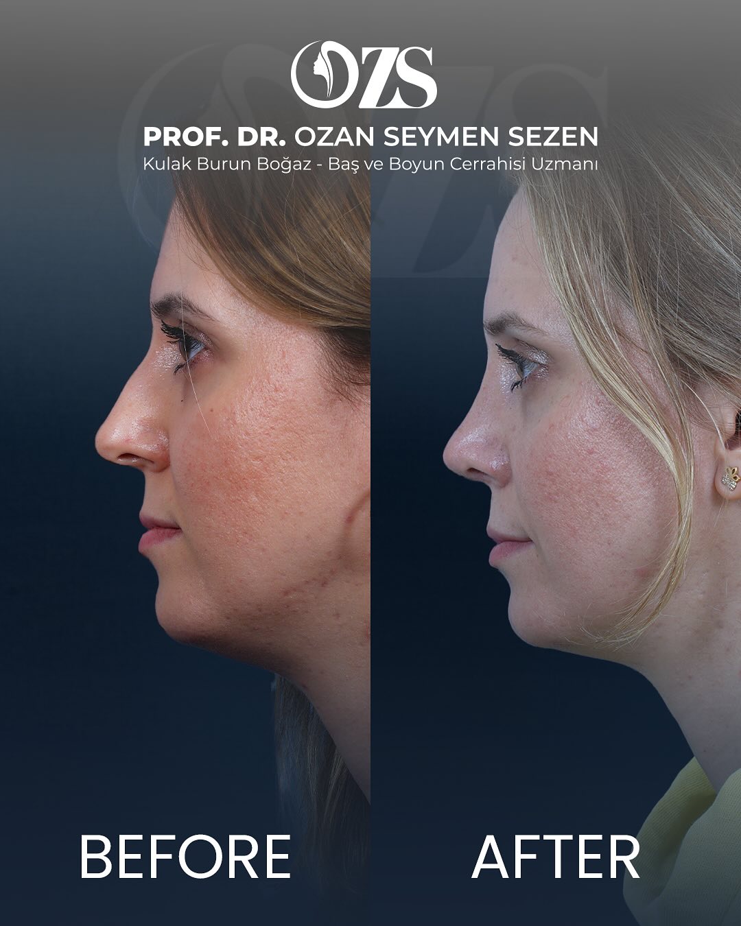 Before-After
