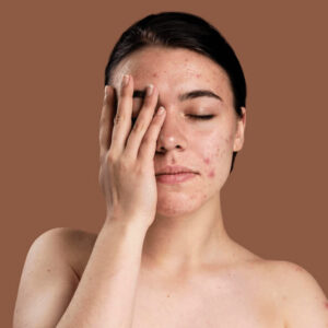 Cancer de la Peau du Visage