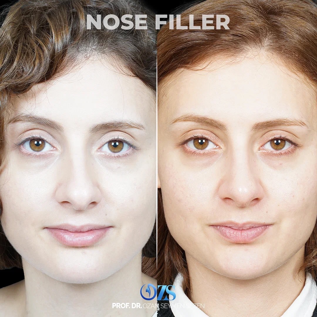 before-after