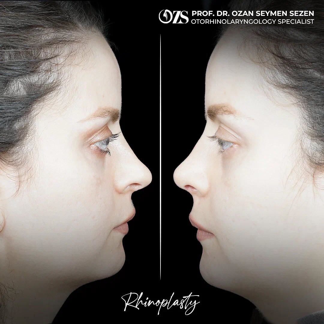 before-after