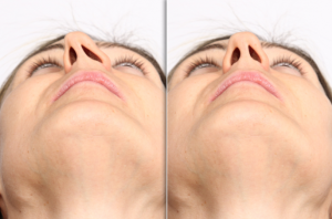 septoplasti-hakknda-her-sey