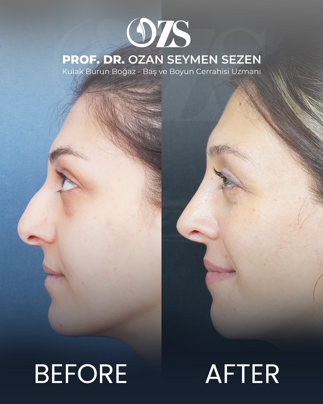 Before-After
