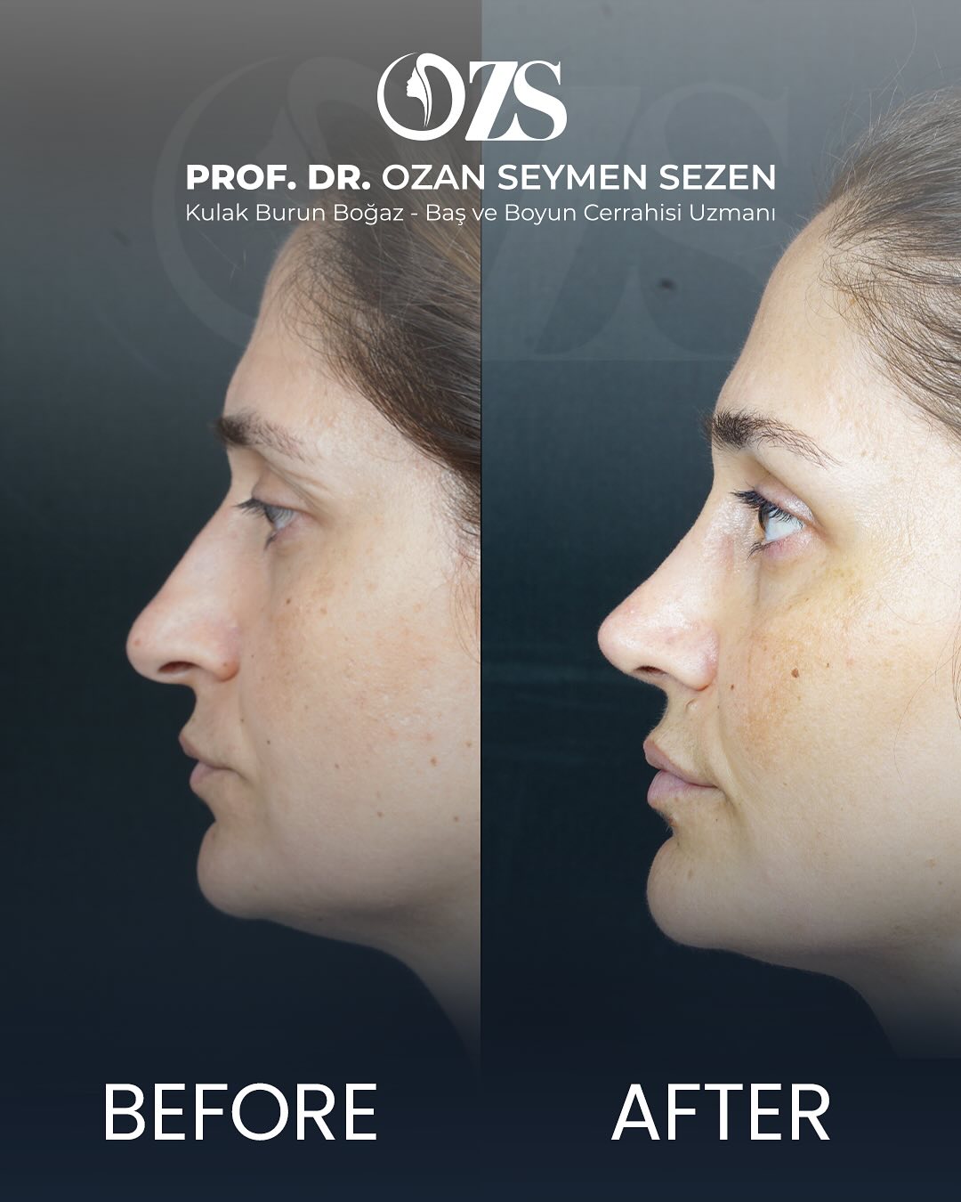Before-After