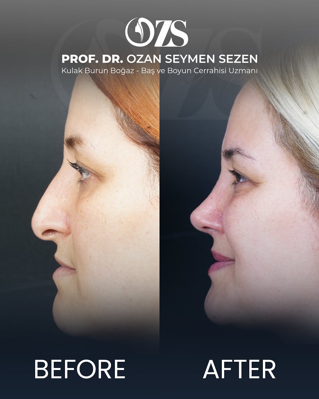 Before-After