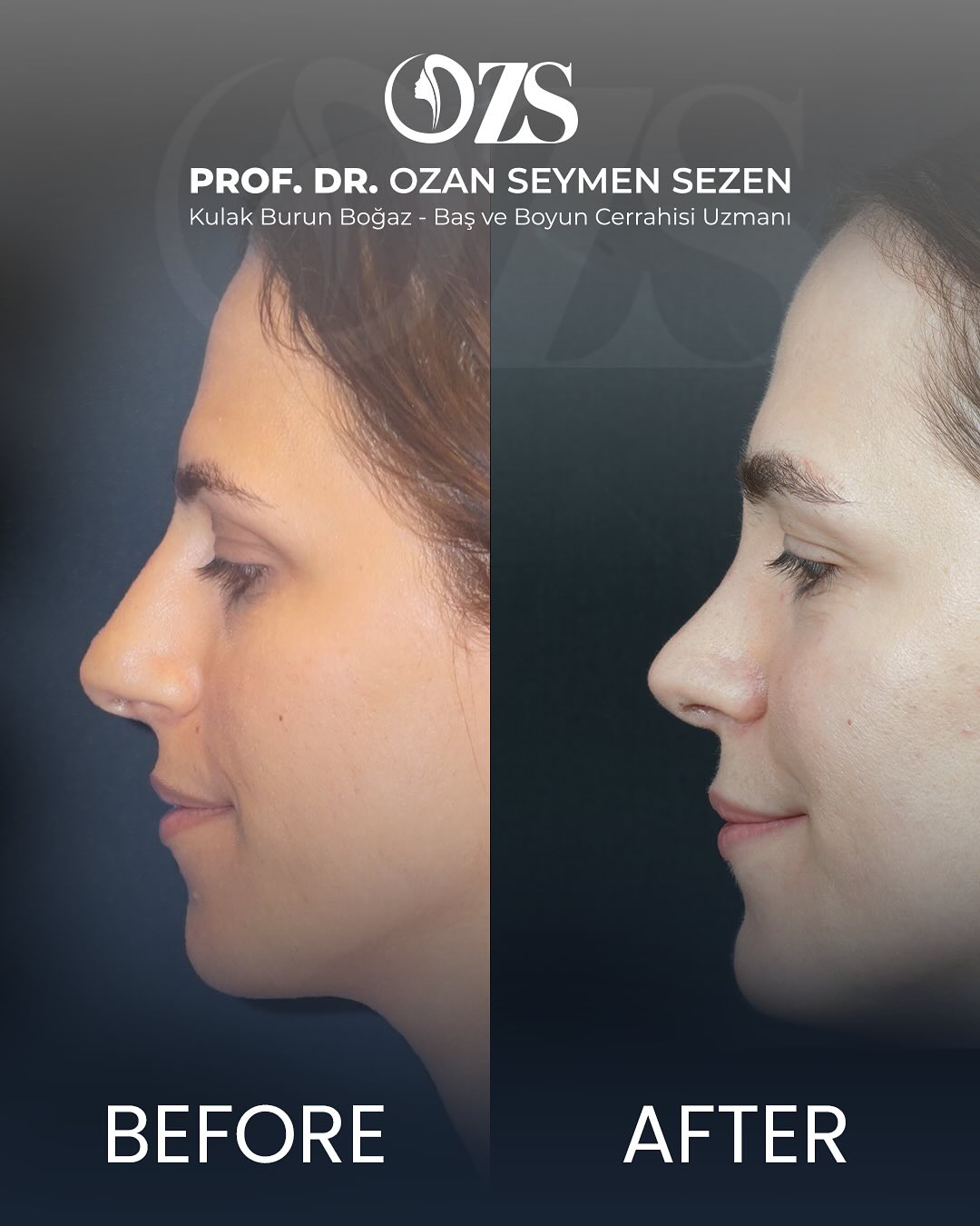 Before-After