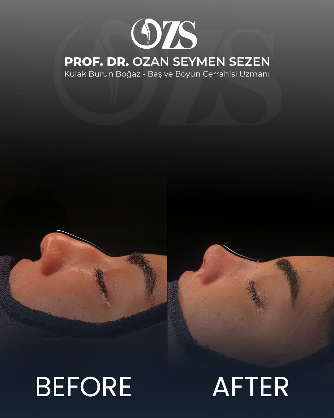 Before-After