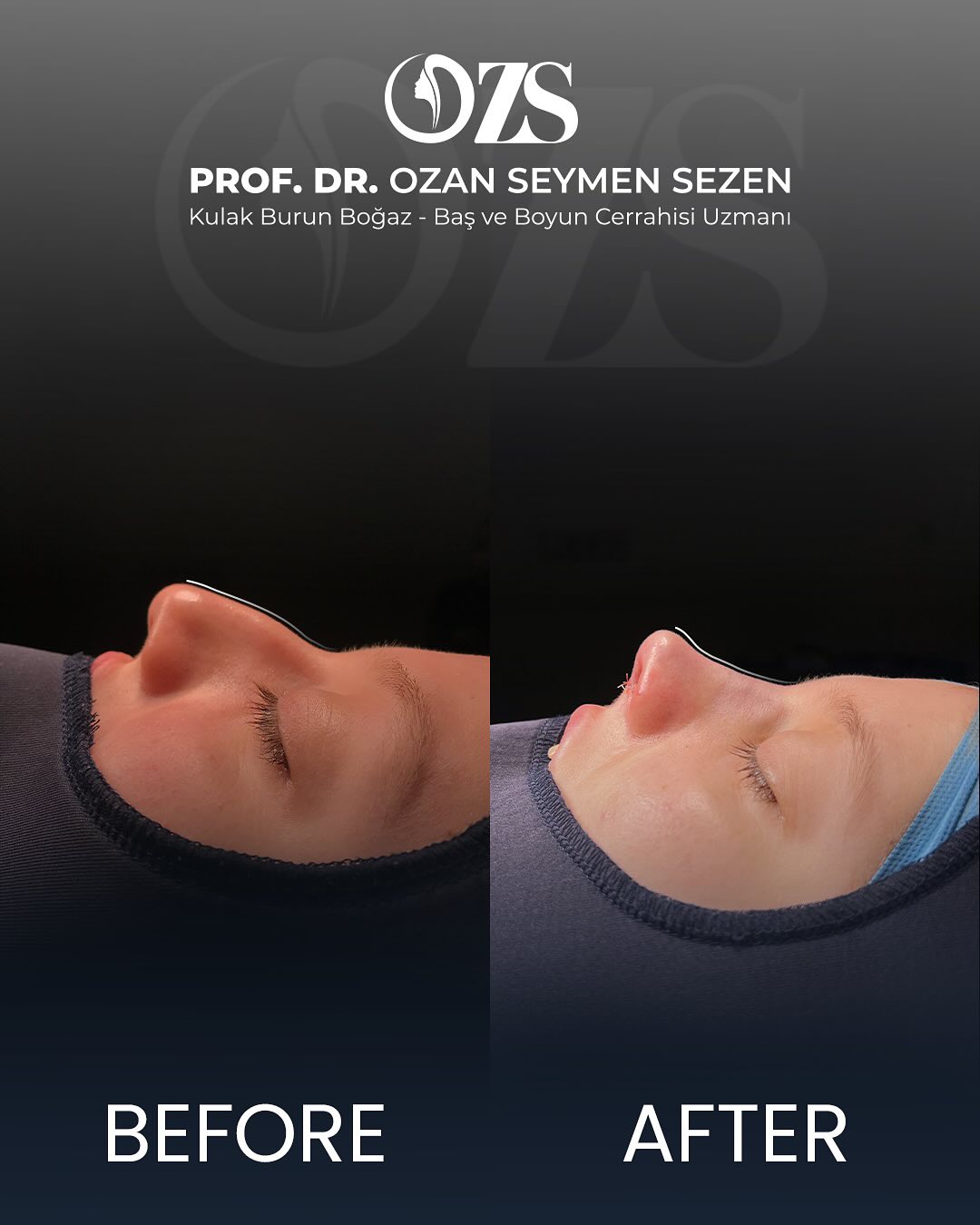 Before-After