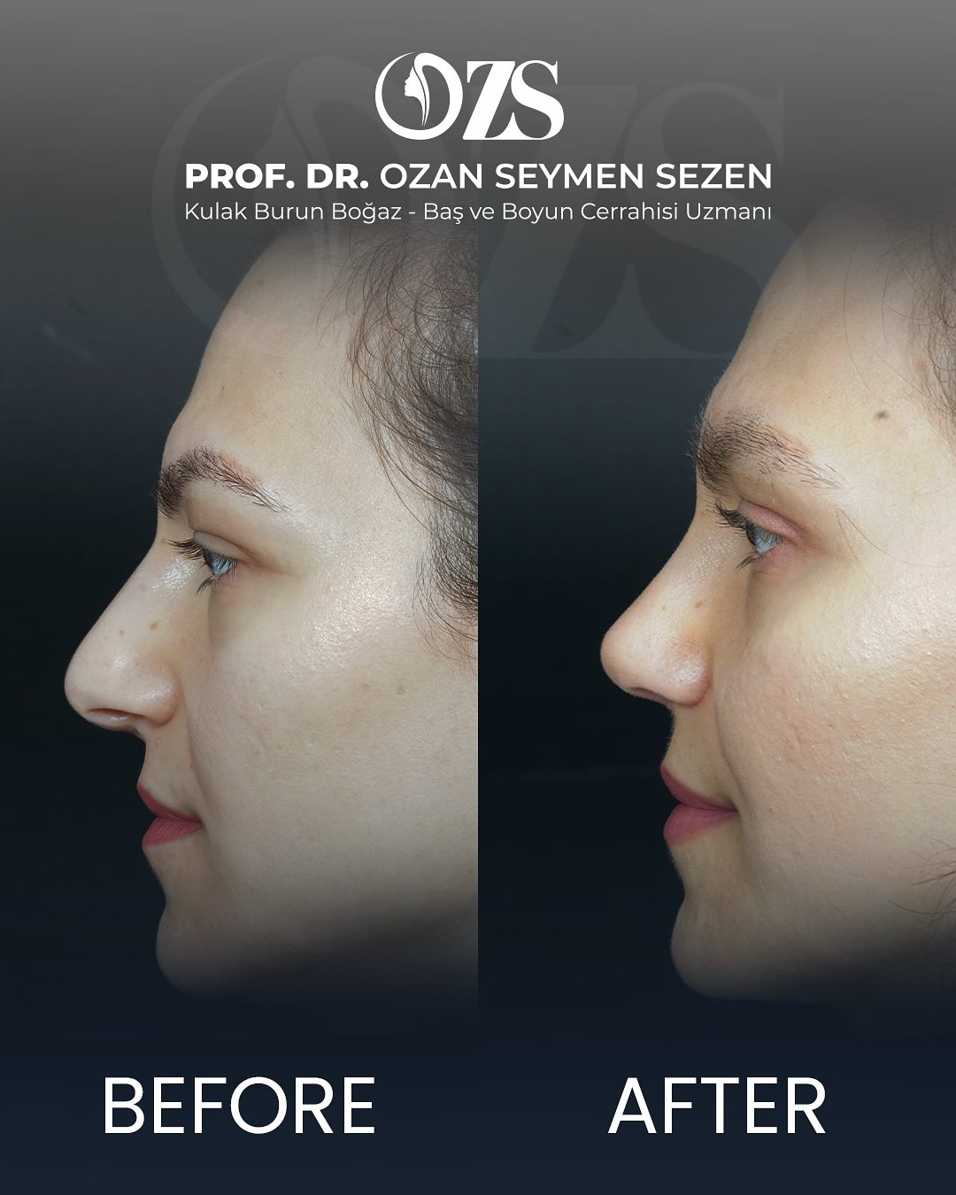 Before-After