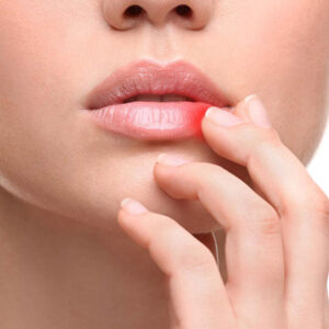 Lip Cancer