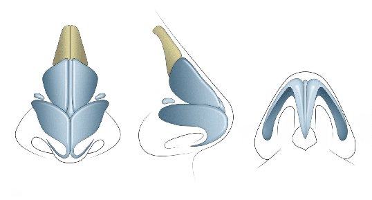 revision rhinoplasty in turkey with rib cartilage