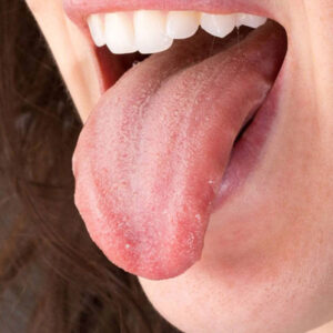 Tongue Cancer