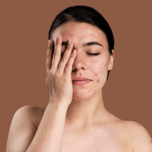 Facial Skin Cancer