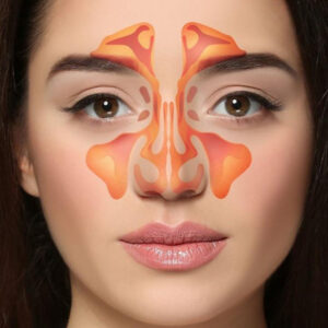 Sinus Cancer